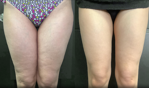 cellulite reduction before after mississauga oakville